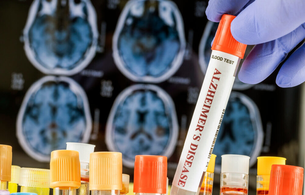 Organoidi cerebrali per la ricerca sull'Alzheimer