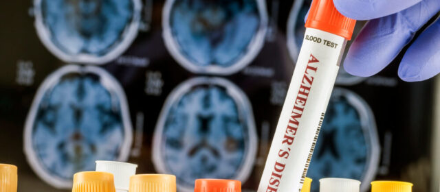 Organoidi cerebrali per la ricerca sull'Alzheimer